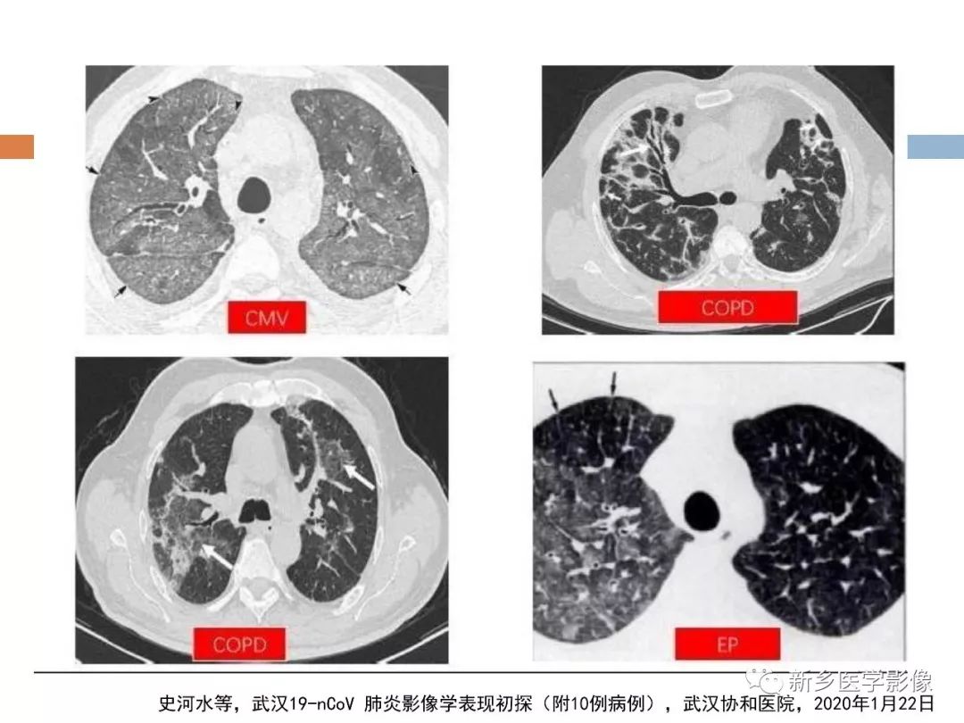 【PPT】2019新型冠状病毒肺炎影像学表现