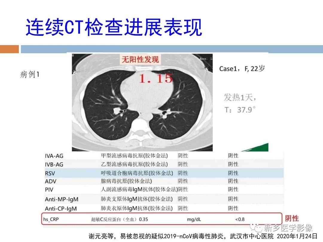 【PPT】2019新型冠状病毒肺炎影像学表现