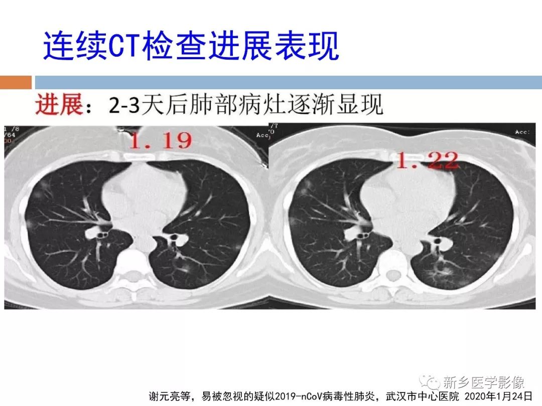 【PPT】2019新型冠状病毒肺炎影像学表现
