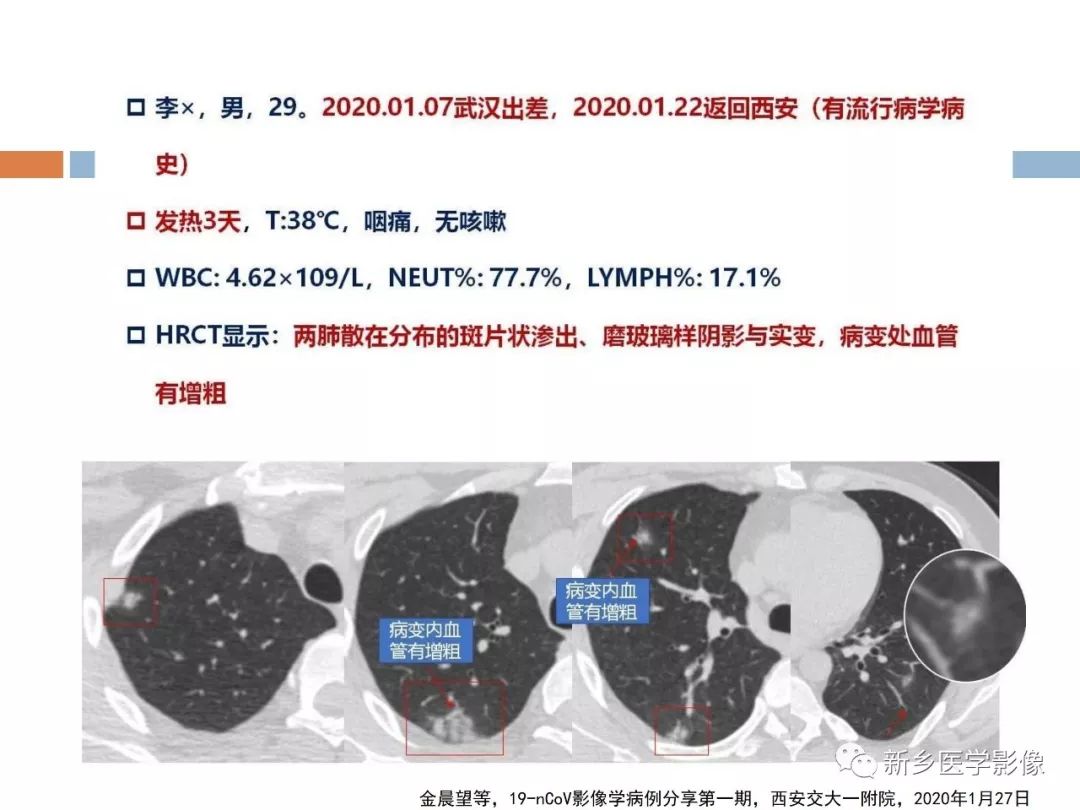 【PPT】2019新型冠状病毒肺炎影像学表现
