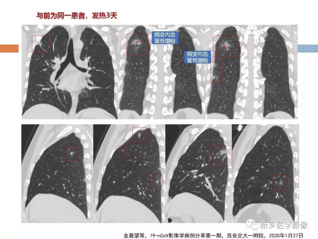 【PPT】2019新型冠状病毒肺炎影像学表现