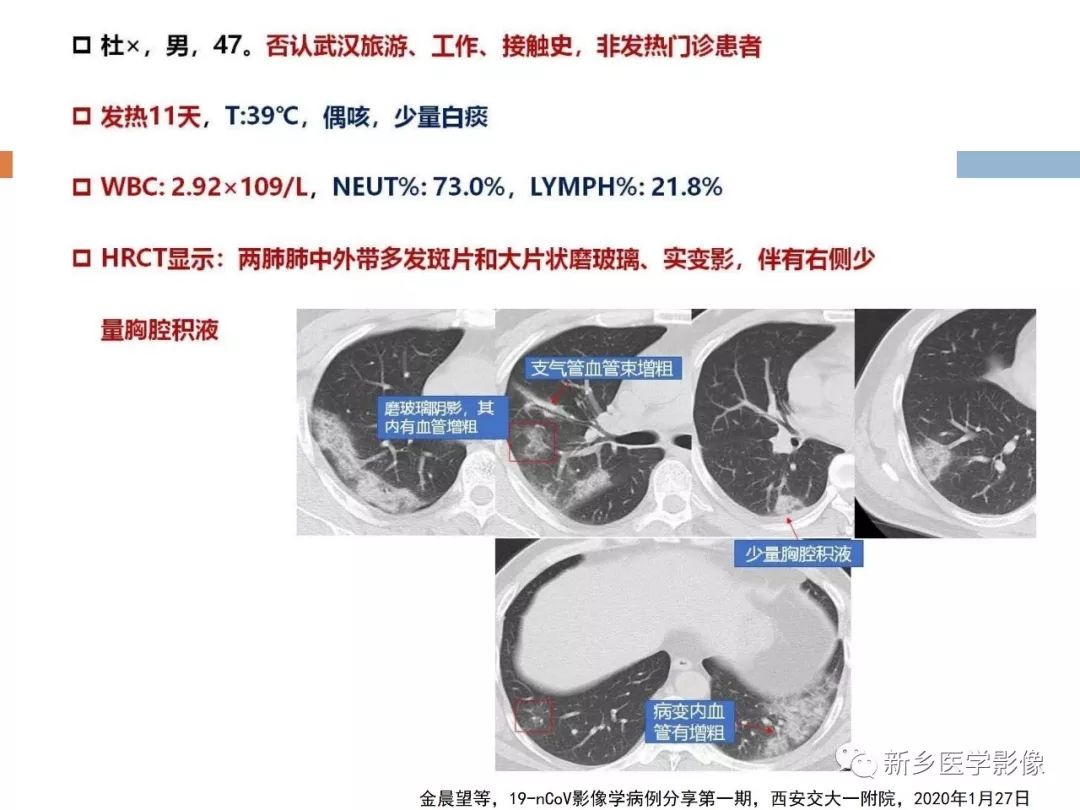 【PPT】2019新型冠状病毒肺炎影像学表现