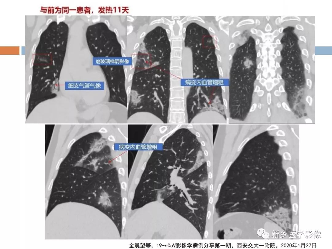 【PPT】2019新型冠状病毒肺炎影像学表现