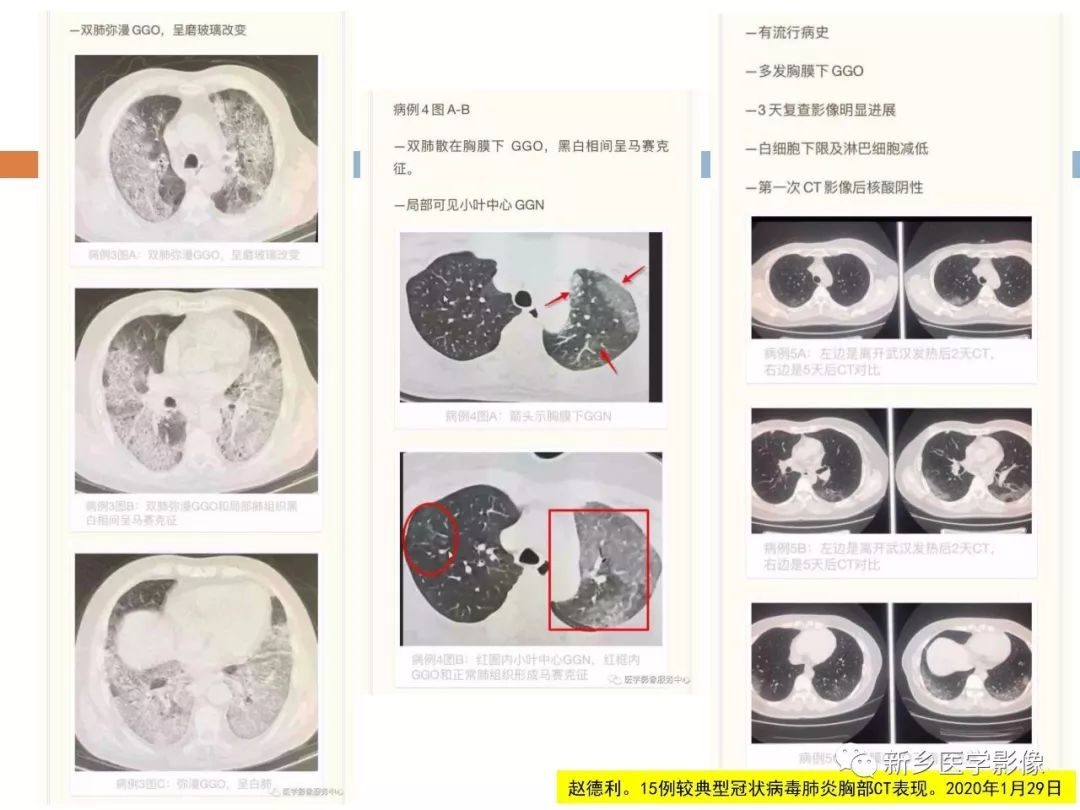 【PPT】2019新型冠状病毒肺炎影像学表现