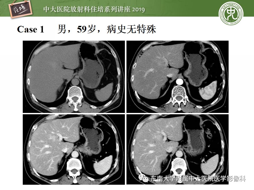 【PPT】肝脏弥漫性病变影像表现