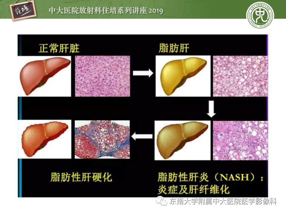【PPT】肝脏弥漫性病变影像表现