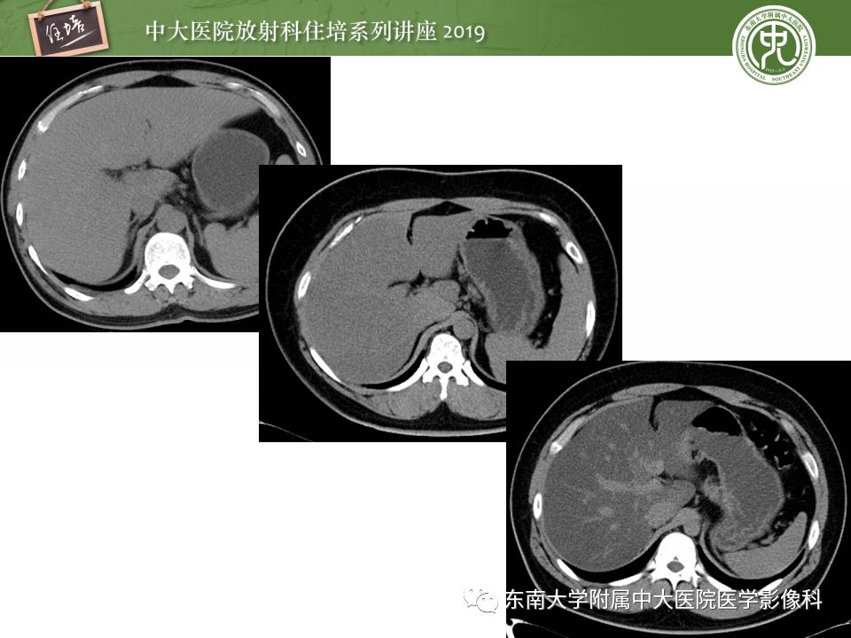 【PPT】肝脏弥漫性病变影像表现