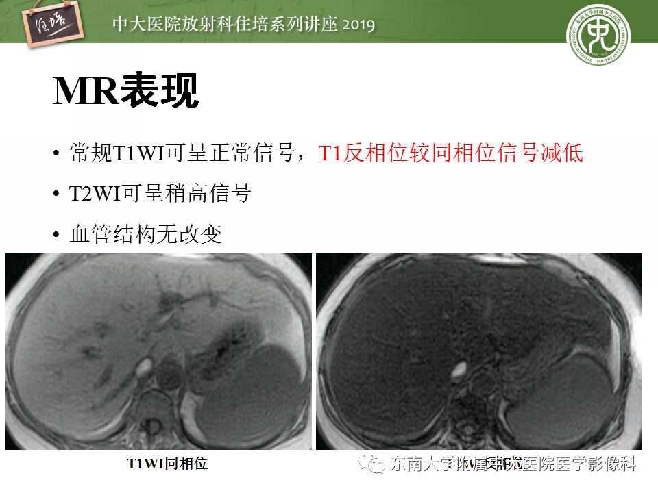 【PPT】肝脏弥漫性病变影像表现