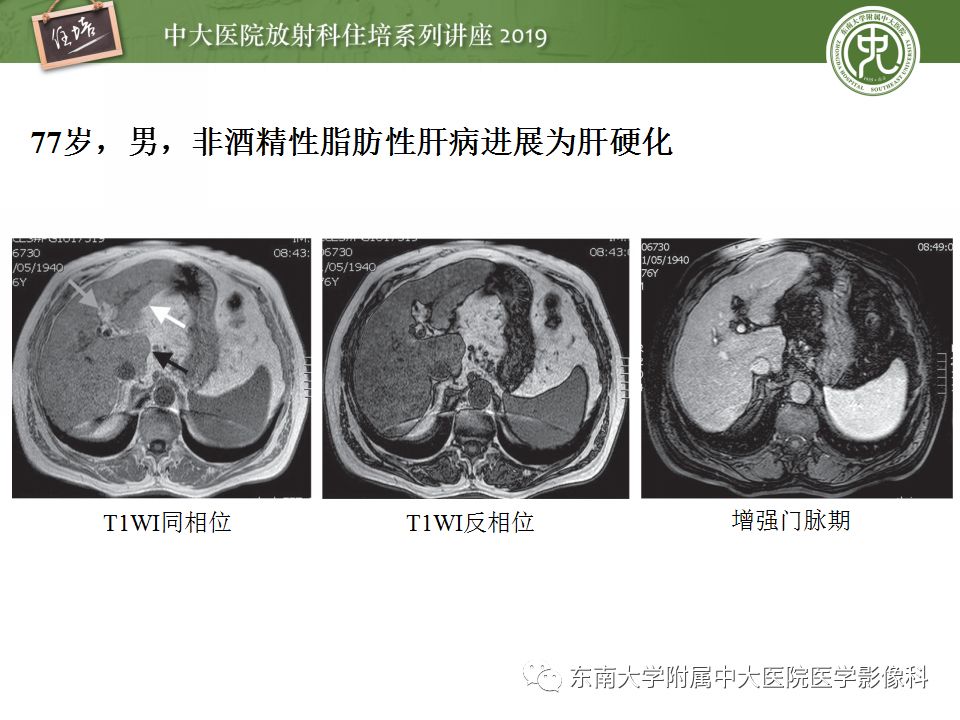 【PPT】肝脏弥漫性病变影像表现