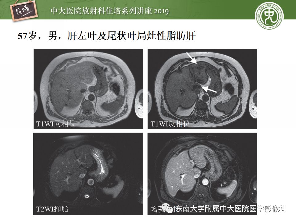 【PPT】肝脏弥漫性病变影像表现
