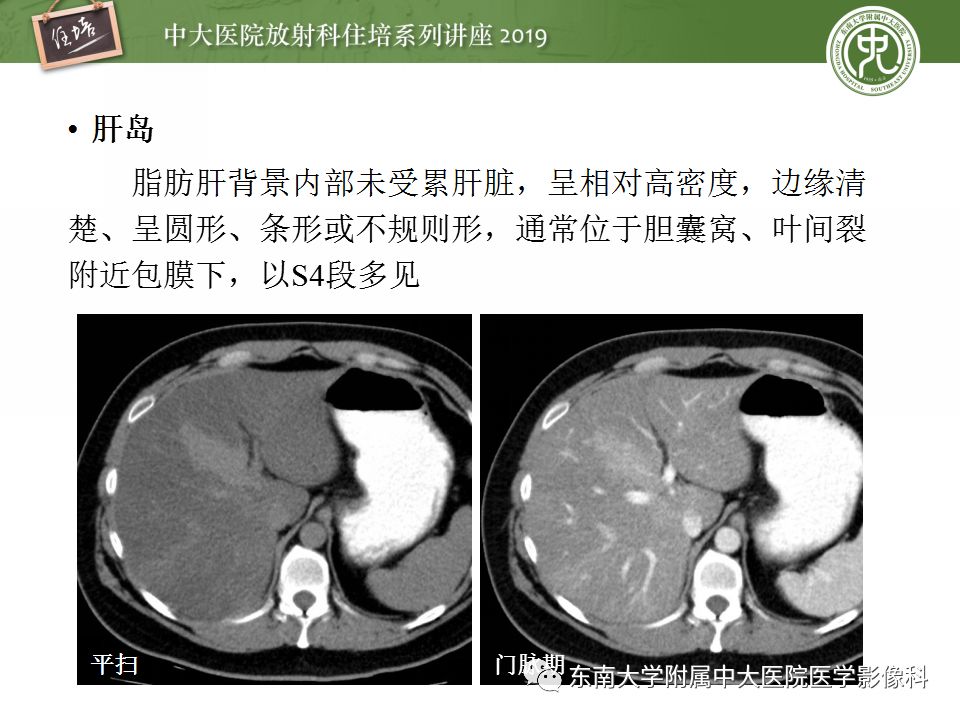 【PPT】肝脏弥漫性病变影像表现