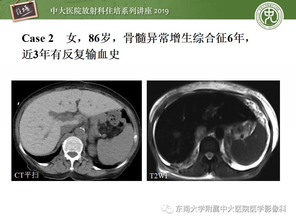 【PPT】肝脏弥漫性病变影像表现