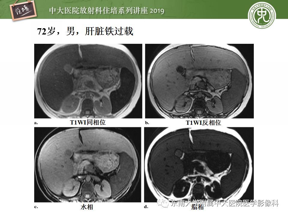 【PPT】肝脏弥漫性病变影像表现