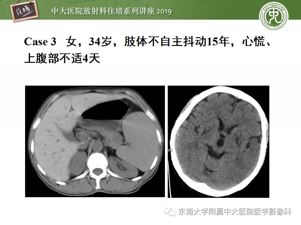 【PPT】肝脏弥漫性病变影像表现