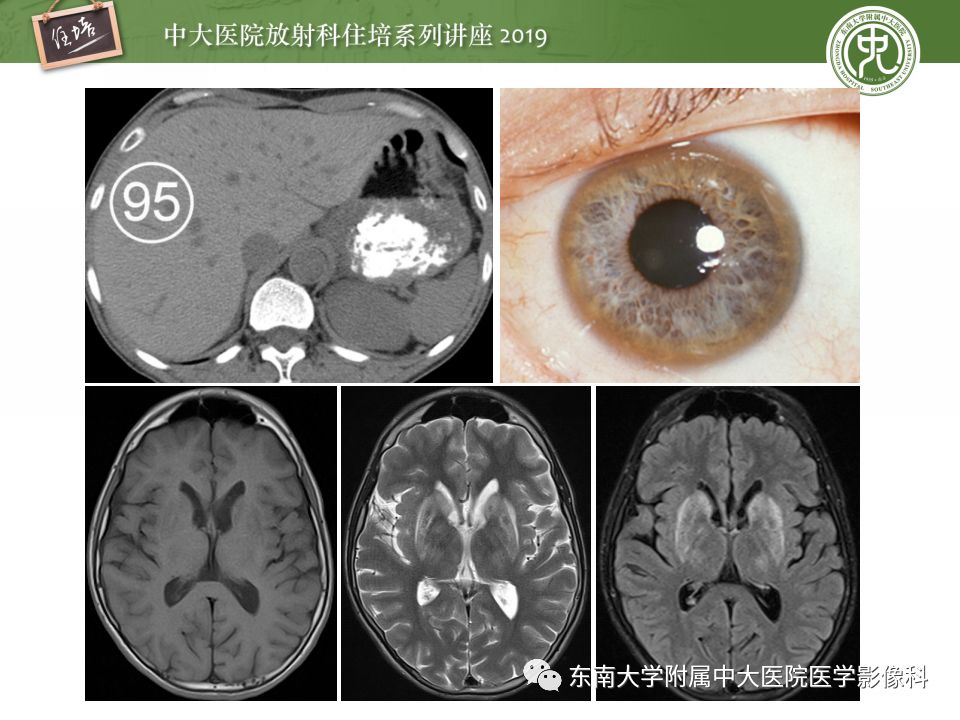 【PPT】肝脏弥漫性病变影像表现