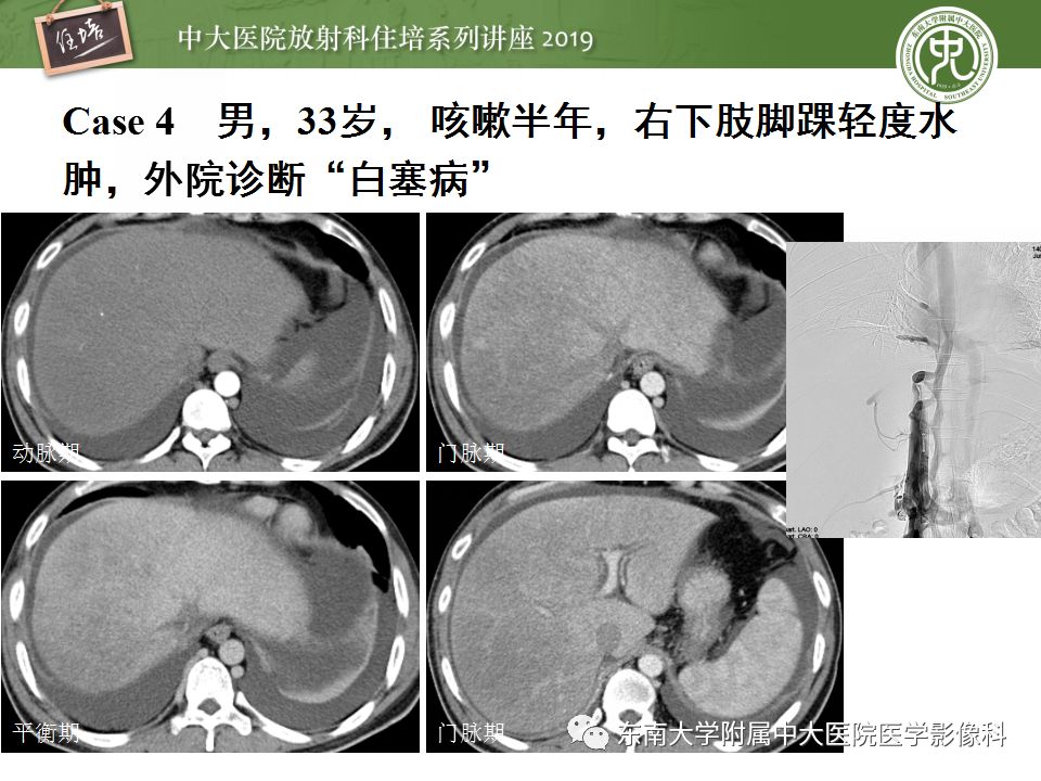 【PPT】肝脏弥漫性病变影像表现