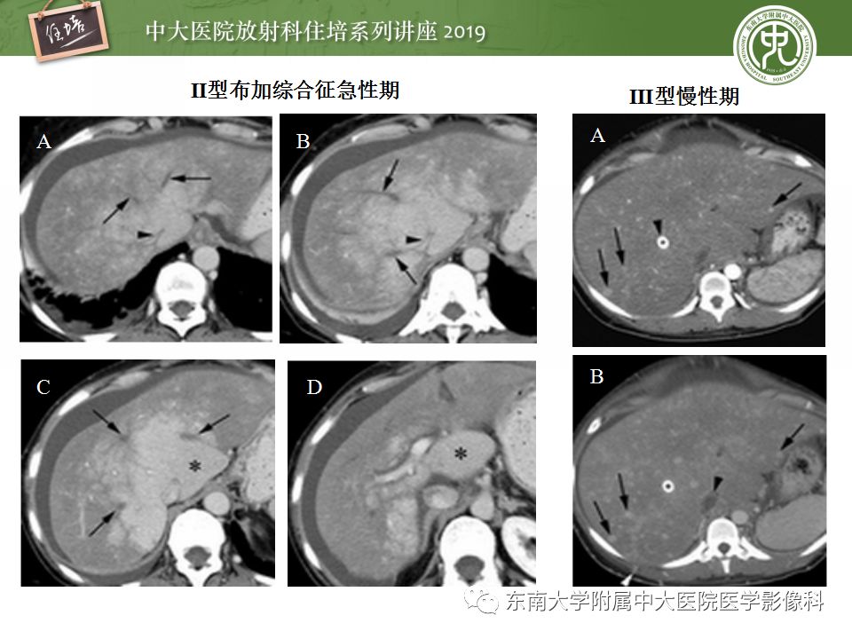 【PPT】肝脏弥漫性病变影像表现