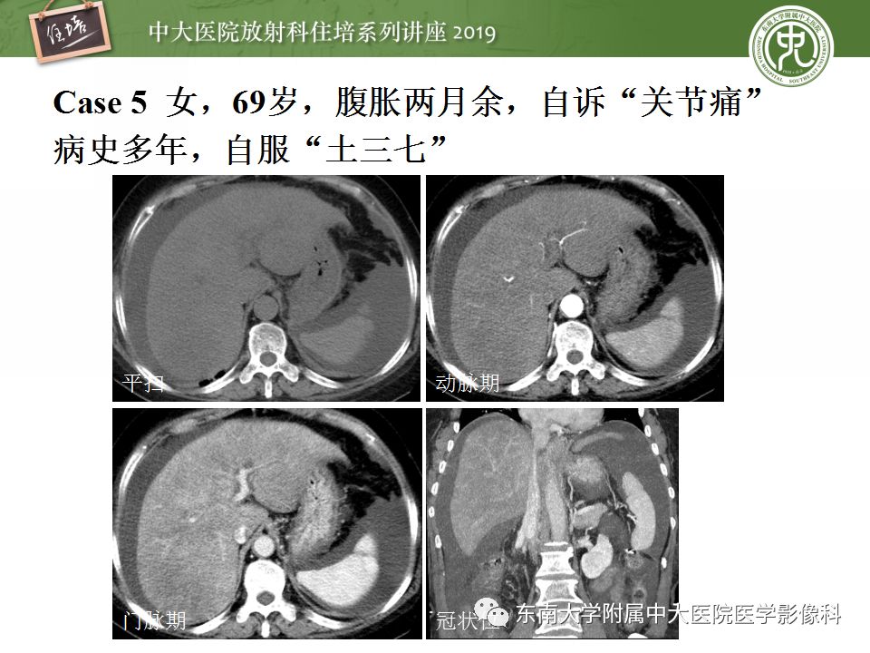 【PPT】肝脏弥漫性病变影像表现