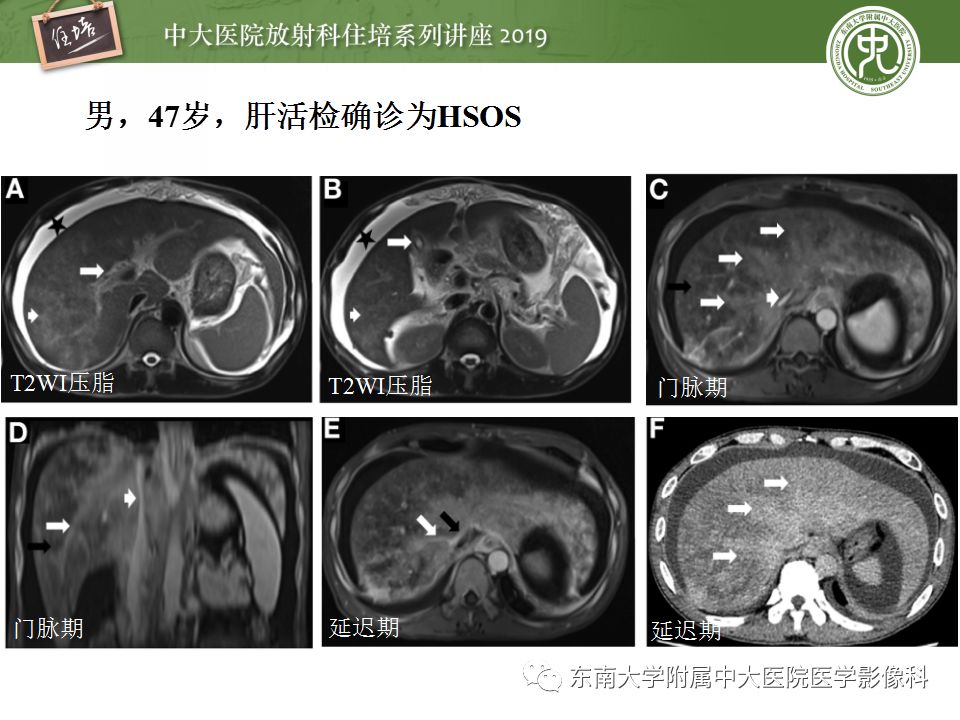【PPT】肝脏弥漫性病变影像表现