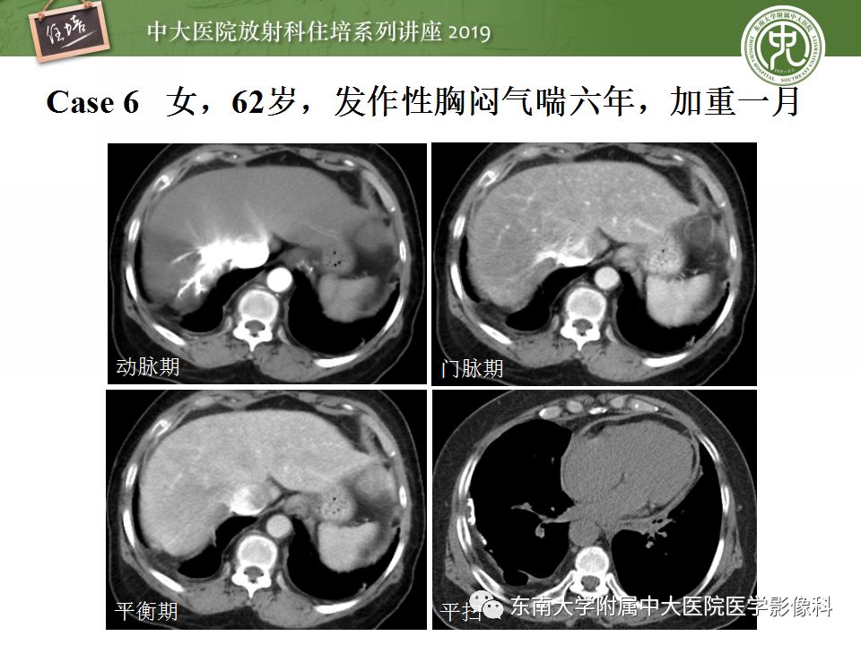 【PPT】肝脏弥漫性病变影像表现