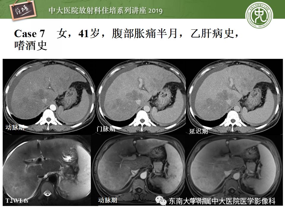 【PPT】肝脏弥漫性病变影像表现