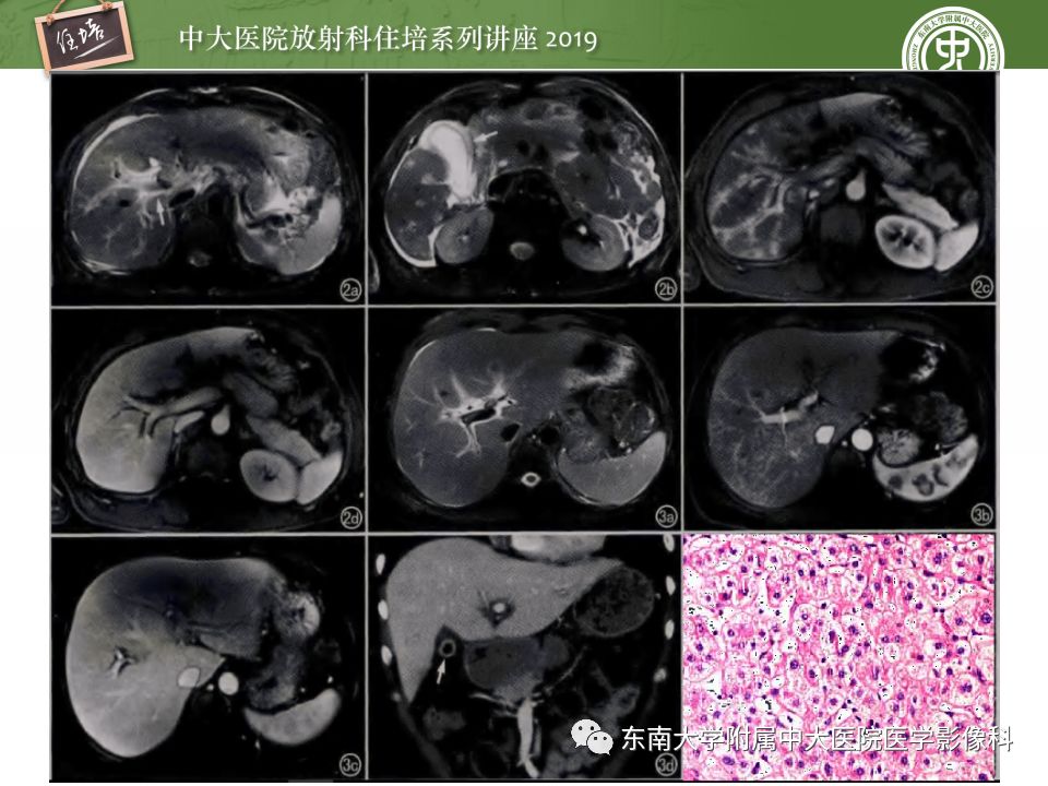 【PPT】肝脏弥漫性病变影像表现