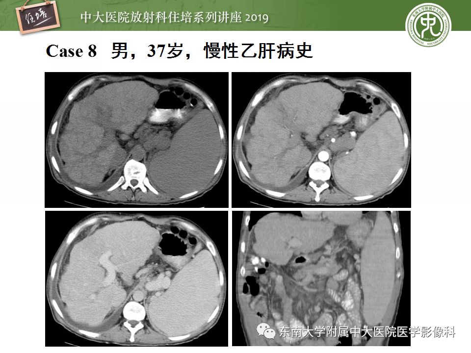 【PPT】肝脏弥漫性病变影像表现