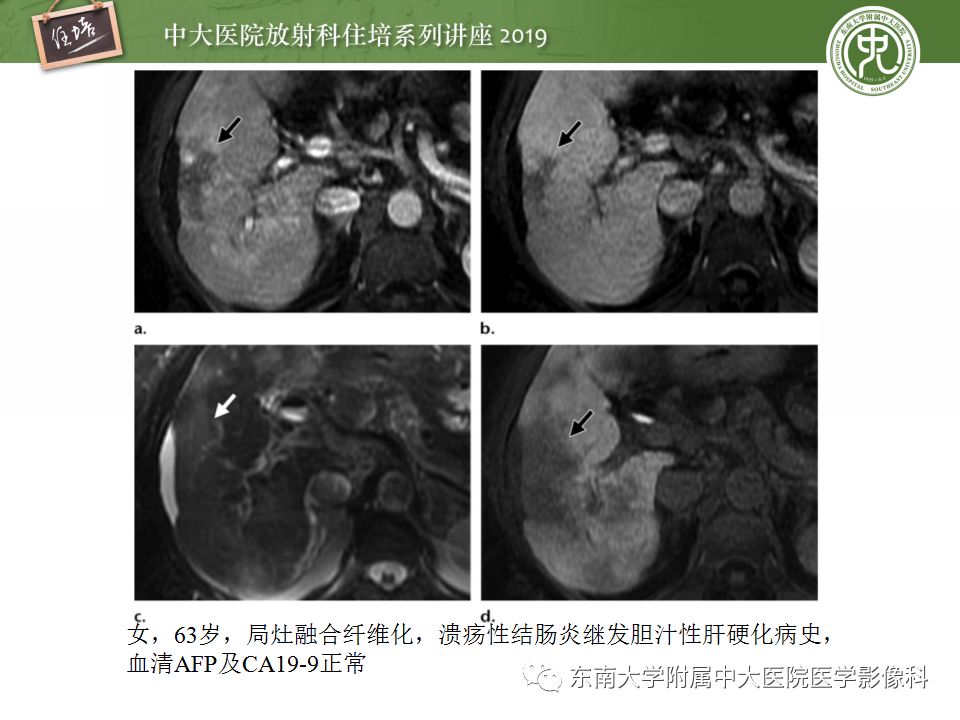 【PPT】肝脏弥漫性病变影像表现
