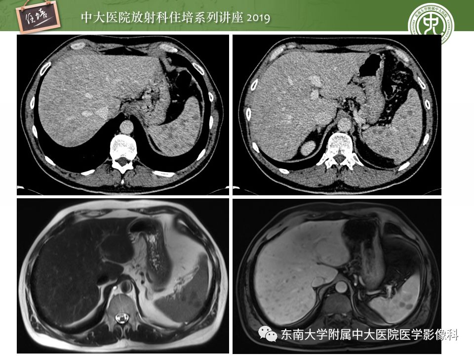 【PPT】肝脏弥漫性病变影像表现