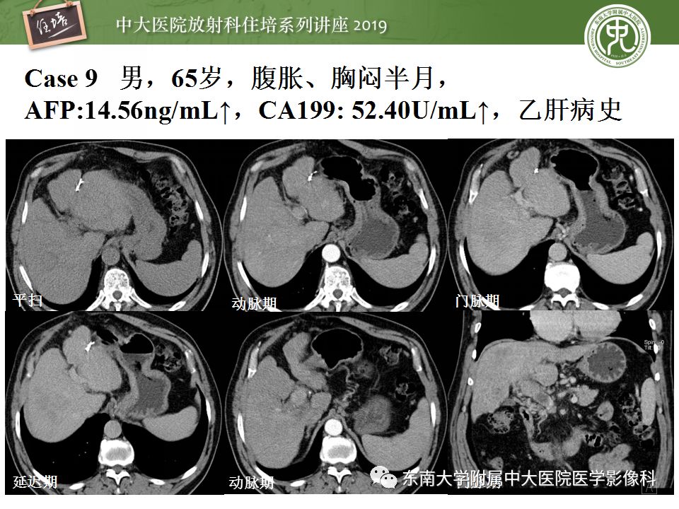 【PPT】肝脏弥漫性病变影像表现