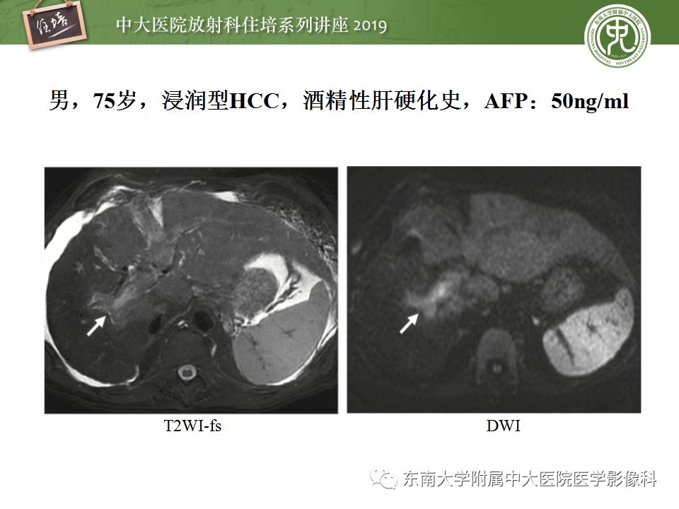 【PPT】肝脏弥漫性病变影像表现
