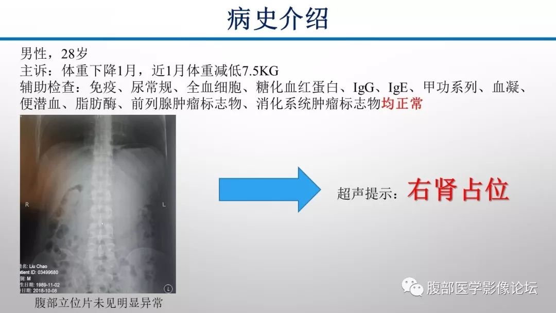 【病例】肾脏孤立性占位影像分析