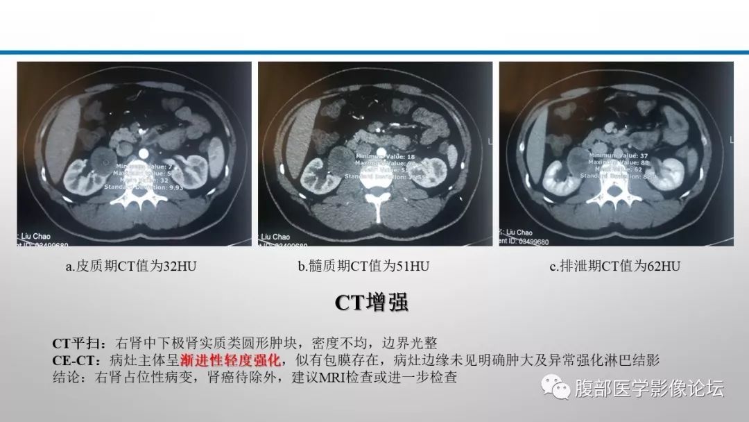 【病例】肾脏孤立性占位影像分析