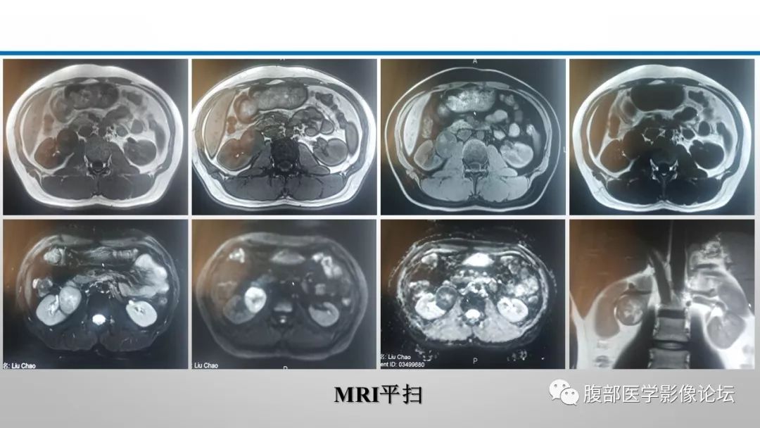 【病例】肾脏孤立性占位影像分析