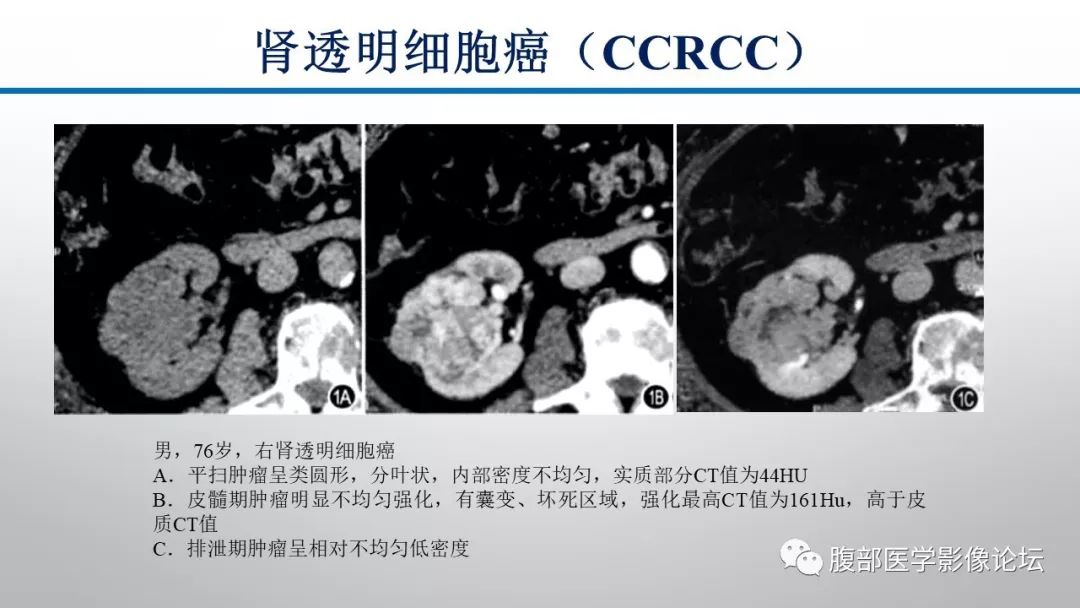 【病例】肾脏孤立性占位影像分析