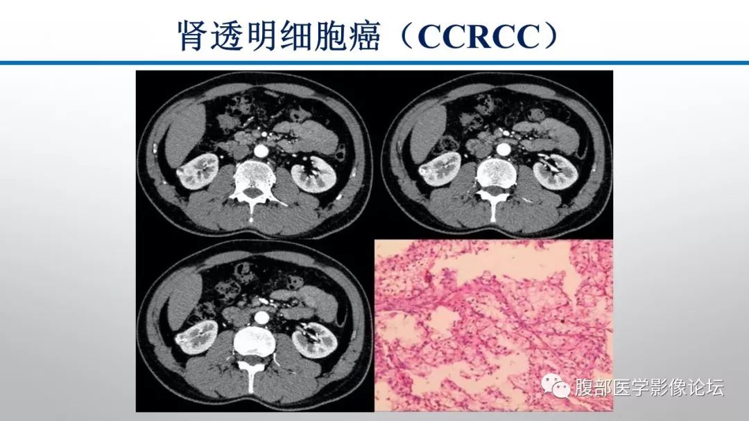 【病例】肾脏孤立性占位影像分析