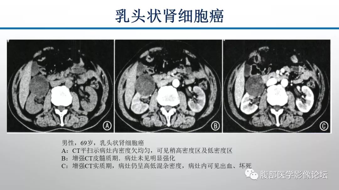 【病例】肾脏孤立性占位影像分析