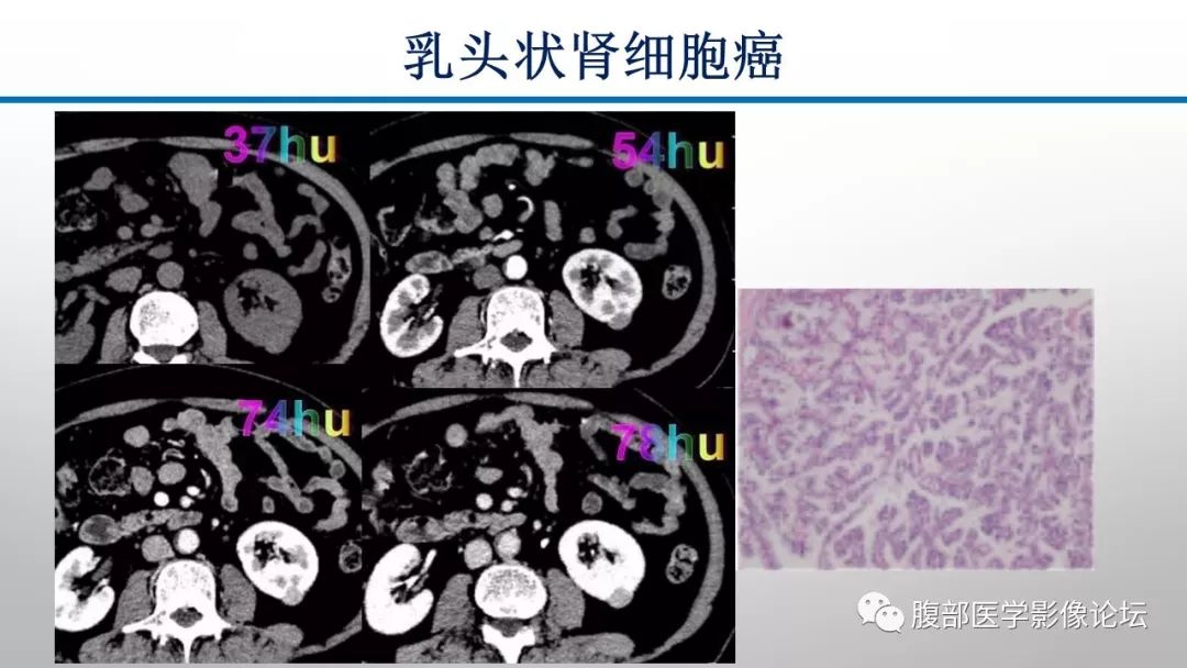 【病例】肾脏孤立性占位影像分析