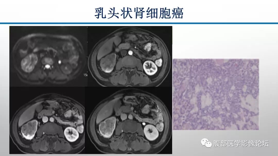 【病例】肾脏孤立性占位影像分析