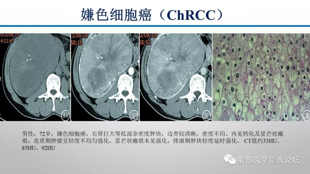 【病例】肾脏孤立性占位影像分析
