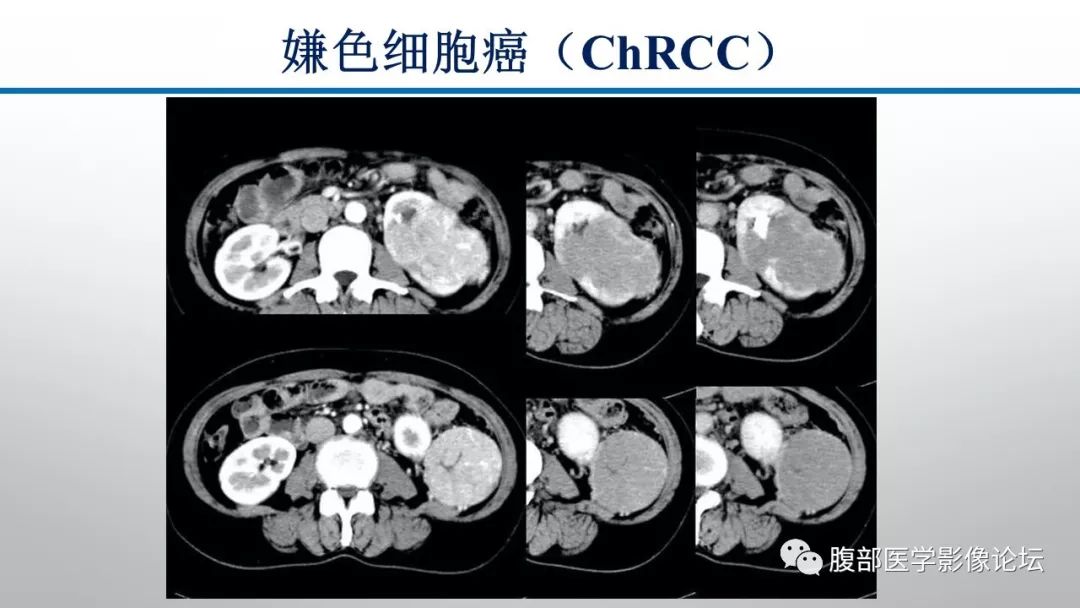 【病例】肾脏孤立性占位影像分析