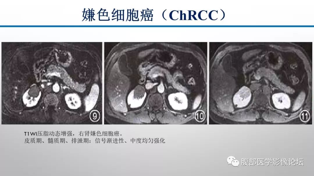 【病例】肾脏孤立性占位影像分析