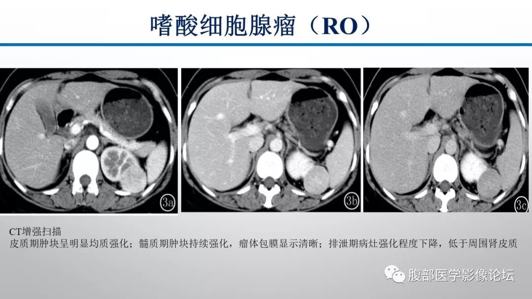 【病例】肾脏孤立性占位影像分析