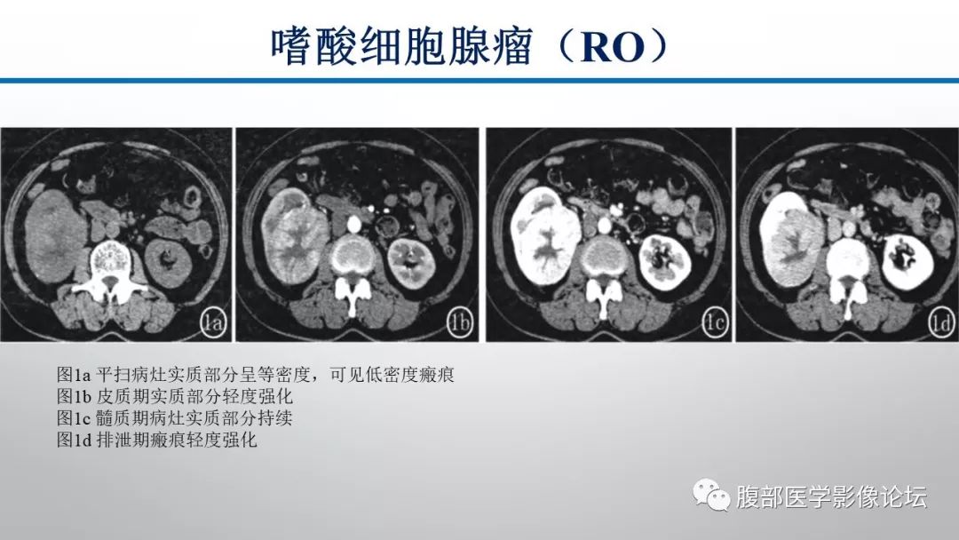 【病例】肾脏孤立性占位影像分析