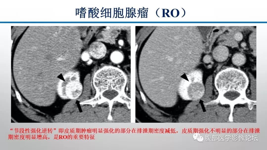 【病例】肾脏孤立性占位影像分析