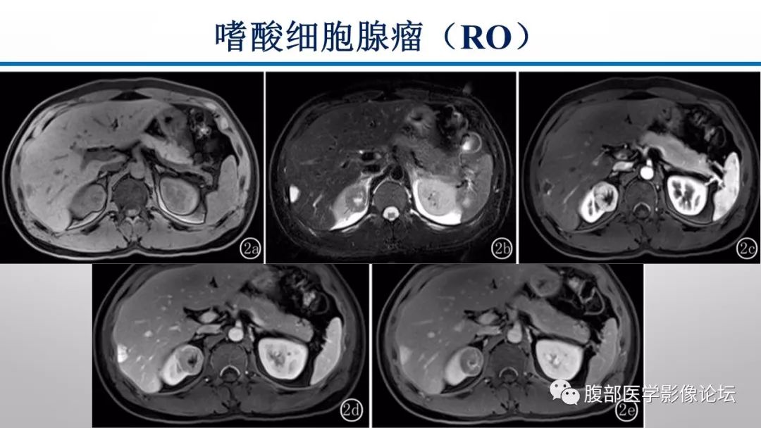【病例】肾脏孤立性占位影像分析
