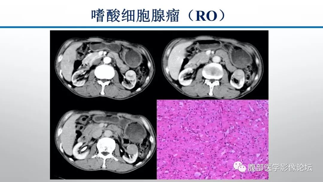 【病例】肾脏孤立性占位影像分析