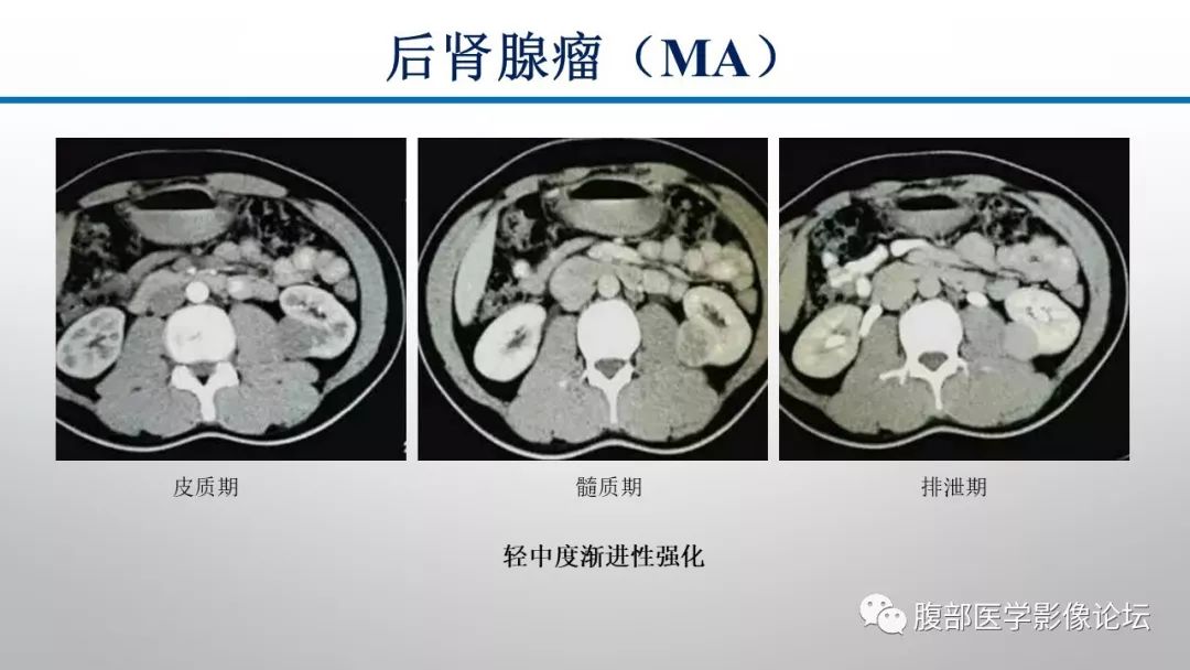 【病例】肾脏孤立性占位影像分析