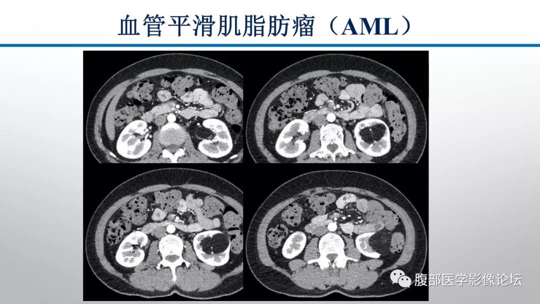 【病例】肾脏孤立性占位影像分析