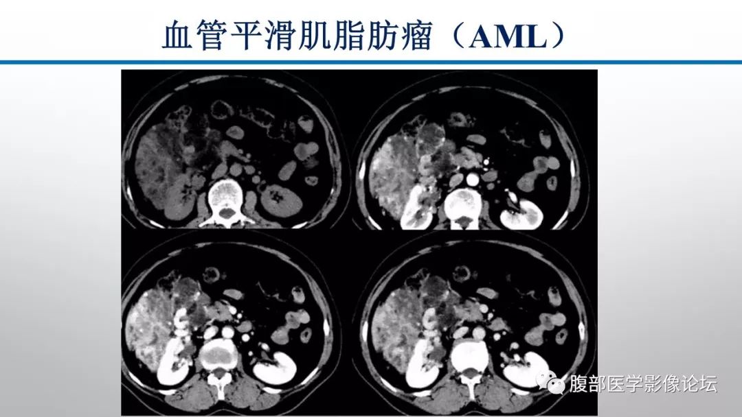 【病例】肾脏孤立性占位影像分析